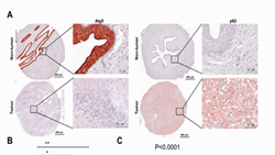 Autophagy Plays a Suppressive Role in Bladder TumorFormation in an Orthotopic Mouse Model and BladderCancer Patient Specimens